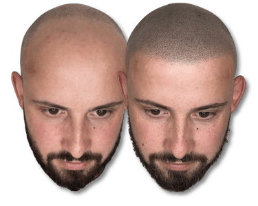 Before and after scalp micropigmentation treatment showing a realistic hairline restoration for male pattern baldness.