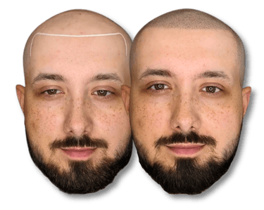 Before and after scalp micropigmentation results for a man with a bald head and beard.