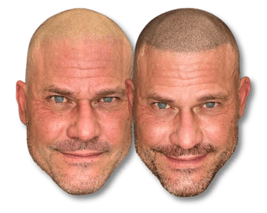 Before and after scalp micropigmentation results showing a realistic hair tattoo hairline on a bald man.