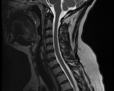 Spine MRI