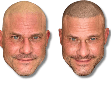 Before and after scalp micropigmentation results for a bald man showing a natural hairline tattoo.