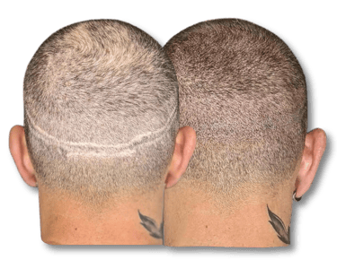 Scalp micropigmentation before and after results concealing a linear hair transplant scar.