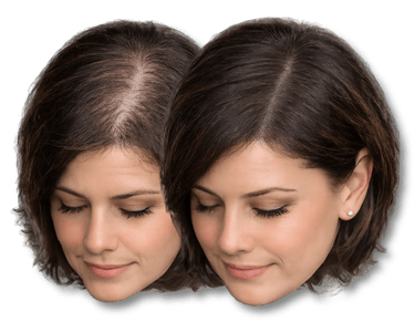Before and after comparison of female hair thinning treatment showing improved scalp coverage.