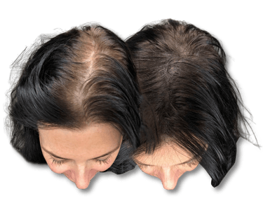 Before and after comparison of female hair thinning and restoration results for scalp regrowth.