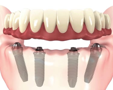 Get fix teeth with Dental Implants
