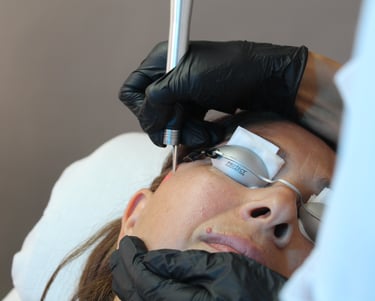 Kvinde får behandling med Glass Skin laser.