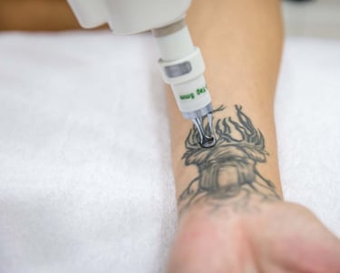 remocion laser de tatuajes