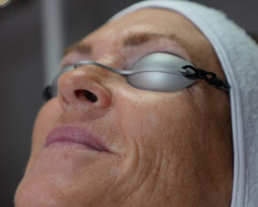 Ansigt, forud for behandling med FRAX Laser.
