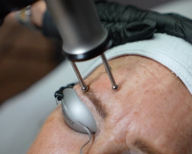 Kvinde får behandling med FRAX Laser.