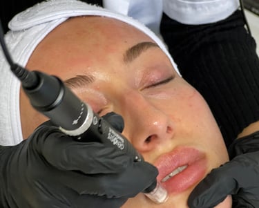 Kvinde modtager behandling hos Skin Room.