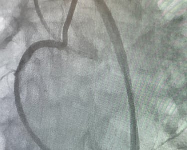 Image de coeur en coronarographie procedure de CTO