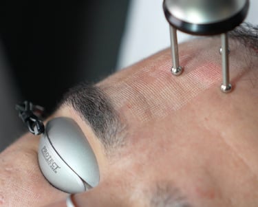 FRAX Laser behandling på ansigt.
