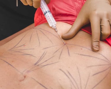 sculptra corporal