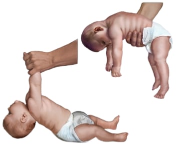 Niños con hipotonía