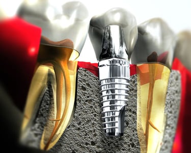 single dental implant cost in Jarabacoa 