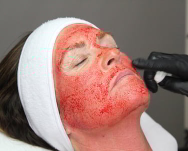 Kvinde får en Vampire Facial behandling.