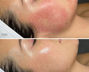 Resultat af behandling med Glass Skin Laser.