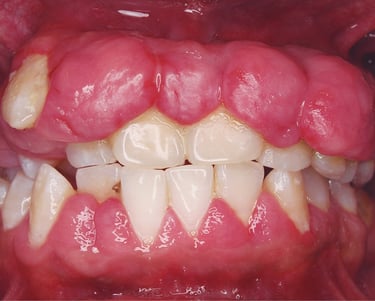 Treatment for bleeding gums