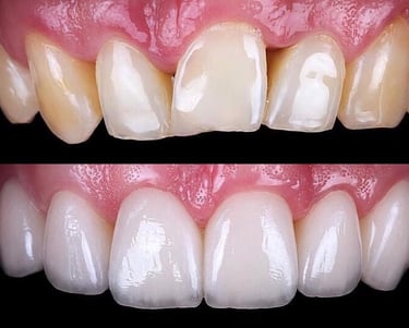 DENTAL VENEER