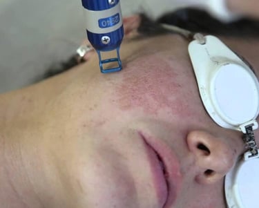 Laser Fraccionado Erbium