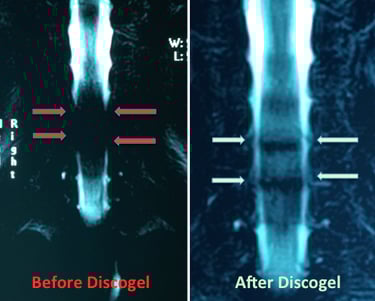 Cervical disc herniation MRI before and after Discogel injection
