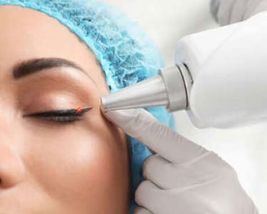 Remoção de tatuagem a laser