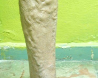Pierna con varices tronculares