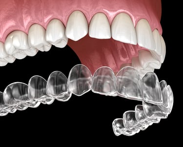 Modello di Invisalign - Gambara 