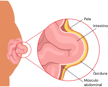 Hérnia no umbigo. Dor na barriga. 