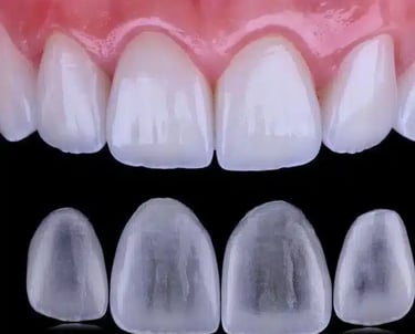 Sorriso bonito com facetas aplicadas por dentista na Lapa PR.