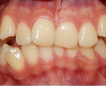 Sonrisa con malposicion dental