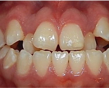 Close Up de una sonrisa con apiñamiento severo.