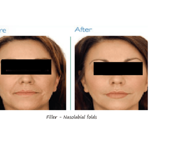 Filler nasolabial folds before and after – smoother skin and younger appearance after correction.