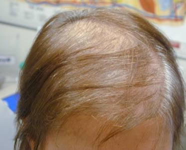 scalp view of thin balding hair prior to Root Revival treatment