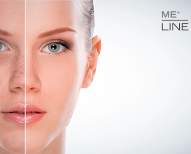 Vrouw waarbij 2 verschillende pigmentsoorten worden getoond op haar gezicht