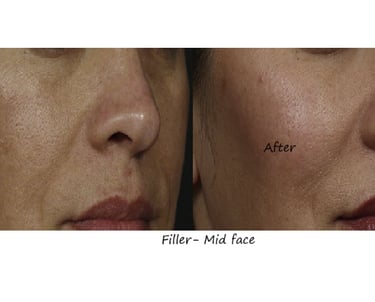 Before & after image fillers cheeks – restored volume, improved contour and natural fullness.