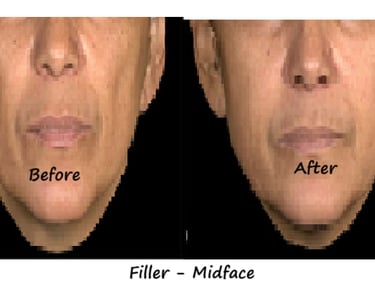 Före- & efterbild filler kinder – återställd volym, förbättrad kontur och naturlig fyllighet.