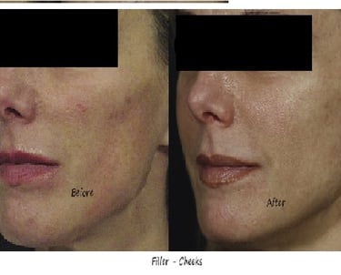 Before & after image filler mid face – improved ogee curve, even skin tone and more radiance.