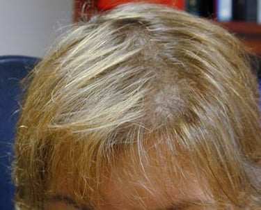 scalp view of fuller thicker hair after Root Revival treatment