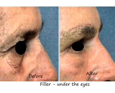 Before and after image filler tear trough – reduced dark circles and shadows under the eyes.