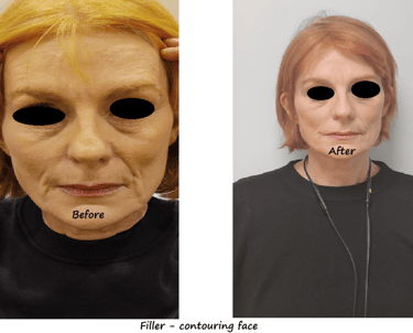 //   Before and after image filler facial contour – restored volume and more harmonious face.