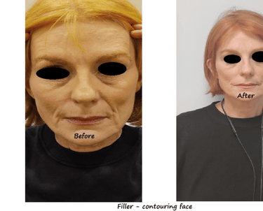 //   Before and after image filler facial contour – restored volume and more harmonious face.