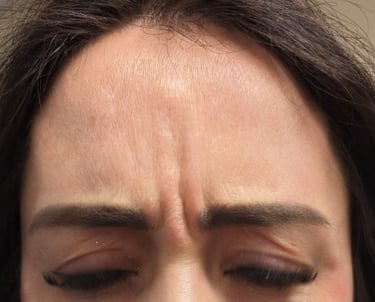 Inspire Salon and Day Spa client before Botox Treatment