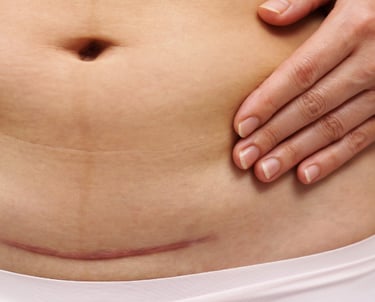 c section scar on woman for scar tissue therapy