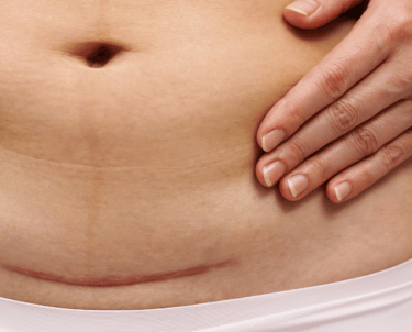 c section scar on woman for scar tissue therapy