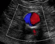 vascular ultrasound imaging perth corewave best artery vein treatment symptom scan doppler bulk bill doctor recommend near me