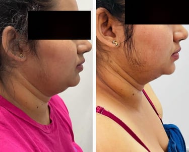 Visible reduction of fine lines after PRP facial at Kandyan Aesthetics
