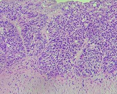 Câncer de ovário, lâmina de microscópio, fotomicrografia, hematoxilina & eosina, adenocarcinoma