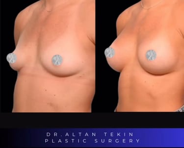 before after photos in Antalya, Türkiye