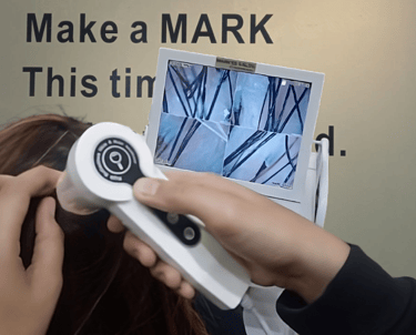 Hair Scalp Analysis